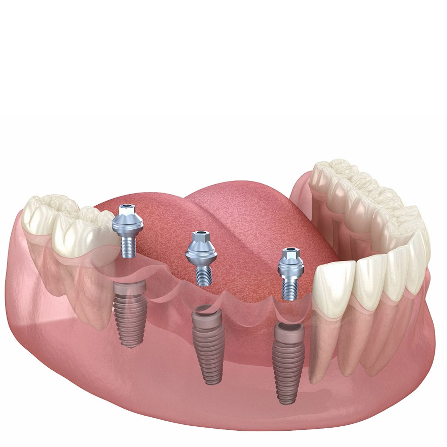 Western Health Turkey